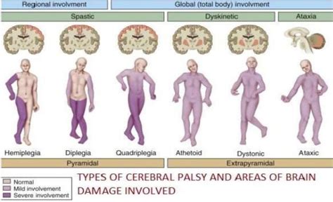 TYPES OF CEREBRAL PLASY | Download Scientific Diagram