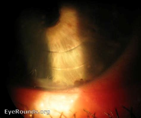 Atlas Entry - Retinal detachment - Shafer's sign