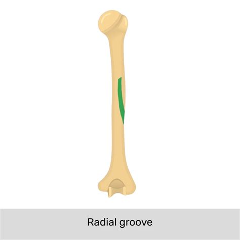 Radial Groove