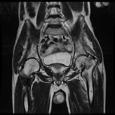 Femoral neck fracture (subcapital) | Image | Radiopaedia.org