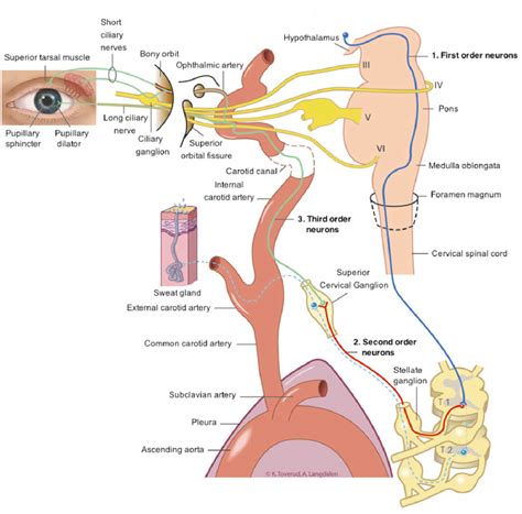 Horner’s Syndrome - MRCP PACES - LearnHaem | Haematology Made Simple