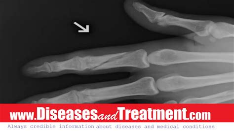 Finger fracture : causes, symptoms, diagnosis, treatment, complications, prevention, surgery ...