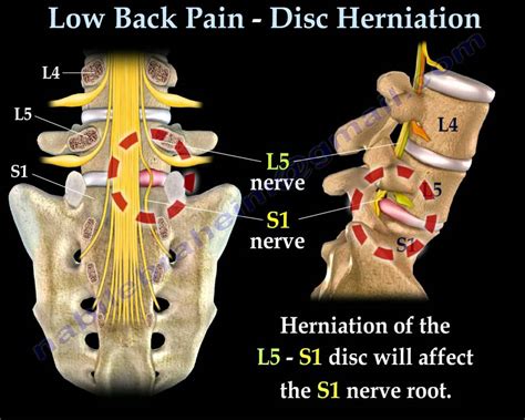 Low Back Pain - Disc Herniation ,Sciatica - Everything You Need To Know ...