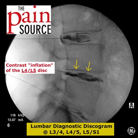 Lumbar Discogram - Lateral view. L4-L5 contrast - The Pain Source - The Pain Source