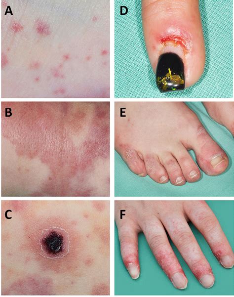 | Pro-inflammatory mechanisms in immune complex vasculitis. Immune ...