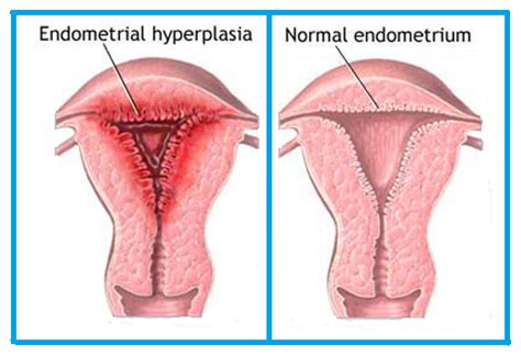 Endometrial Hyperplasia Warning - Handley Law