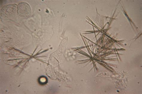 Types of Crystals in Urine