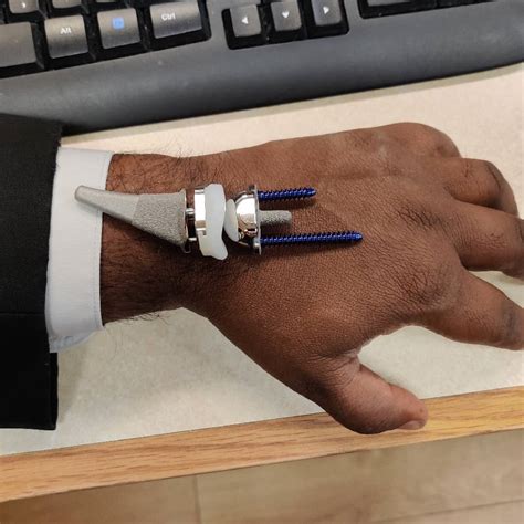 Greenwich Hand Surgeon Designs New Wrist Implant | Greenwich Sentinel | Greenwich Sentinel