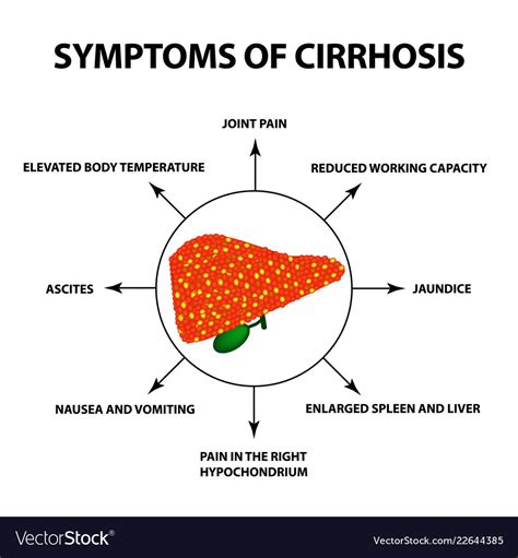 Symptoms of cirrhosis infographics Royalty Free Vector Image