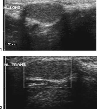 Thyroglossal Duct Cyst Ultrasound