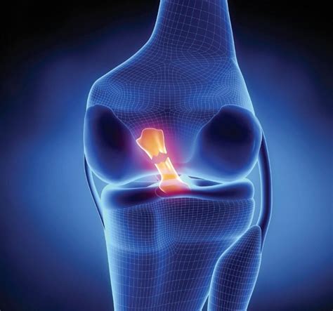 ACL rupture picture - Physio Plus