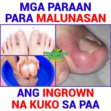 Mga Paraan Para Malunasan Ang Ingrown Na Kuko Sa Paa | Mga Paraan Para Malunasan Ang Ingrown Na ...