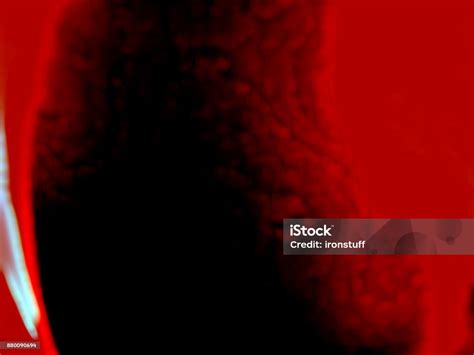 Blood Clotted Thrombus Stock Photo - Download Image Now - Blood Clot ...