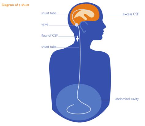 What is Hydrocephalus? – Spina Bifida and Hydrocephalus Association of ...