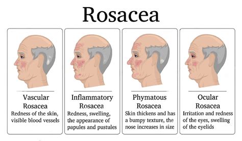 Rosacea - Asia Wellness Medical Centre - Medical Aesthetics & Wellness