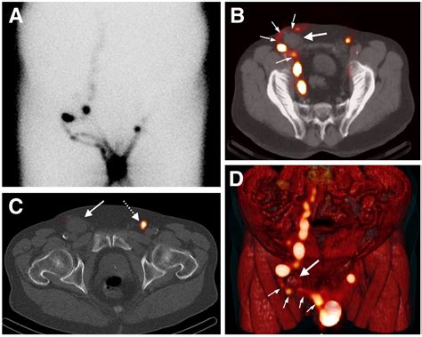 Pelvic Lymph Nodes Anatomy Ct Figure 13 Pelvic Lymph Nodes And | Images and Photos finder