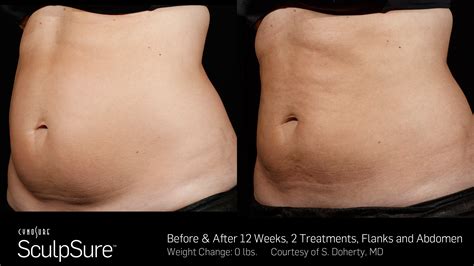 SCULPSURE, Zap the Fat | Premier Plastic Surgery