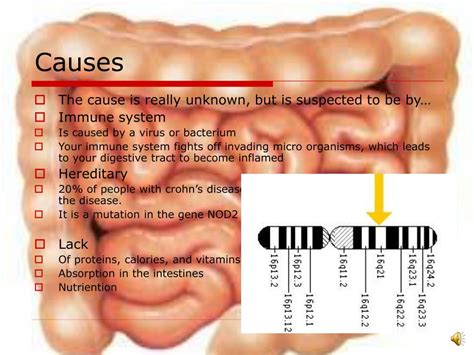 PPT - Crohn’s Disease PowerPoint Presentation, free download - ID:4954621