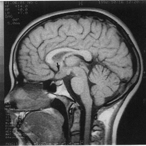 (PDF) Neurosarcoidosis masquerading as glioma of the optic chiasm in a ...