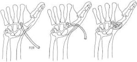 Figure 1 from Ligament reconstruction/tendon interposition arthroplasty ...