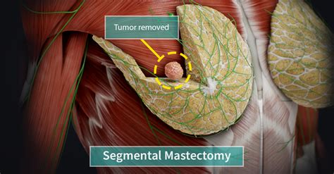 Types of Mastectomy | Complete Anatomy