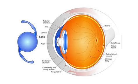 Types of intraocular lens for cataract surgery | Dr Anisha Gupta