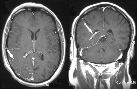 Sturge Weber Mri