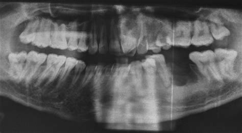 Orthopantomogram of the patient. | Download Scientific Diagram