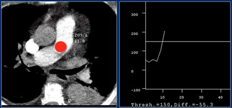 The Radiology Assistant : CT contrast injection and protocols