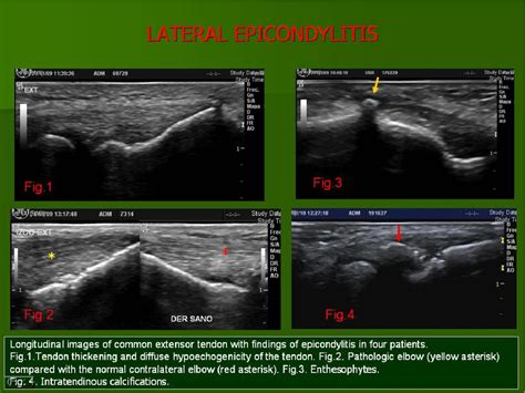 Figure 20 from Ultrasound of the elbow, what the radiologist should know. | Semantic Scholar