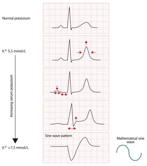 ECG changes due to electrolyte imbalance (disorder) – Cardiovascular ...