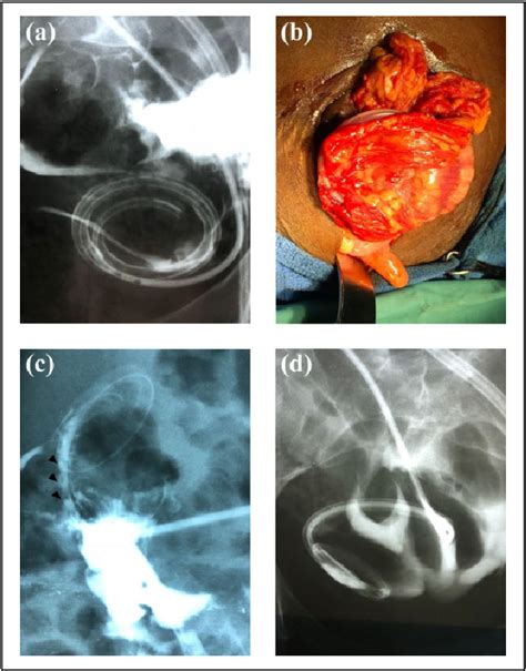 Figure 1 from Omental wrap: Radiographic diagnosis confirmed surgically – Report of two cases in ...