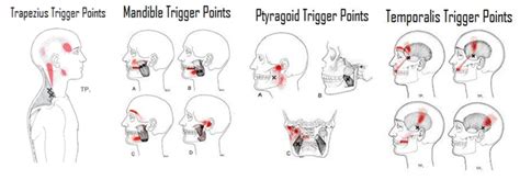 Trigger Point Treatment of TMJ | Moyer Total Wellness