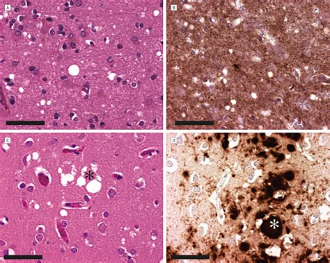 Human Prion Diseases: Molecular and Clinical Aspects | Infectious Diseases | JAMA Neurology ...