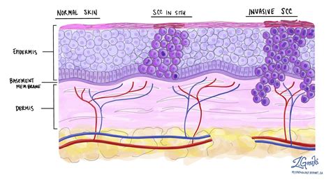 Squamous cell carcinoma in situ of the skin | MyPathologyReport.ca