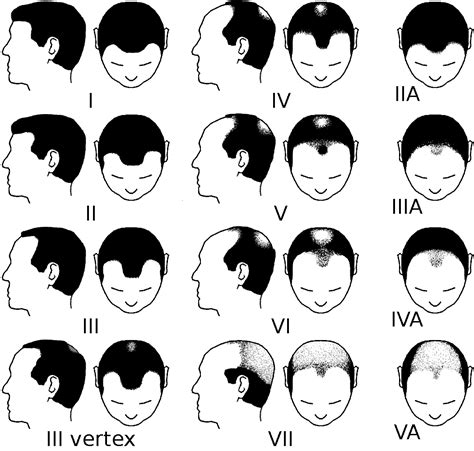 Hamilton-Norwood Scale for Male Pattern Baldness | Norwood Scale / Norwood Reaper | Know Your Meme