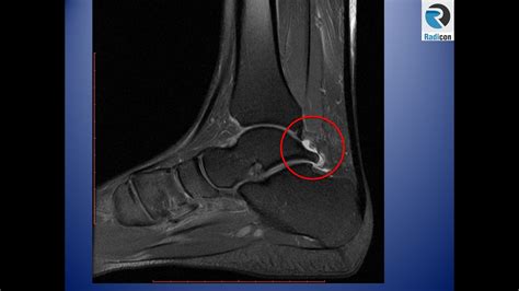 Ankle MRI Part 3: Impingement - YouTube