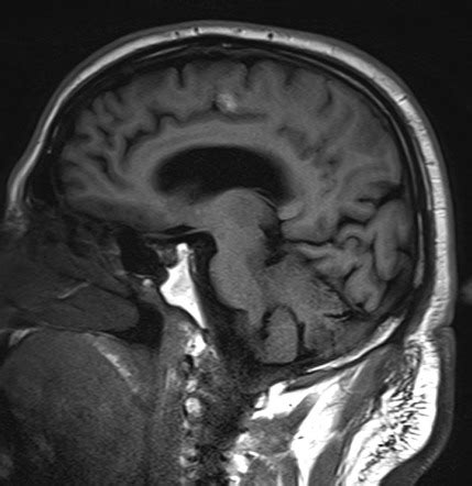 Ossification of the falx cerebri - focal | Image | Radiopaedia.org