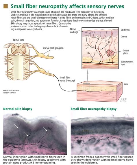 367 best images about CIDP, Small Fiber Neuropathy & Chronic Illnesses ...