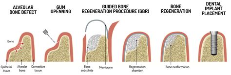 Optimising bone regeneration in dentistry