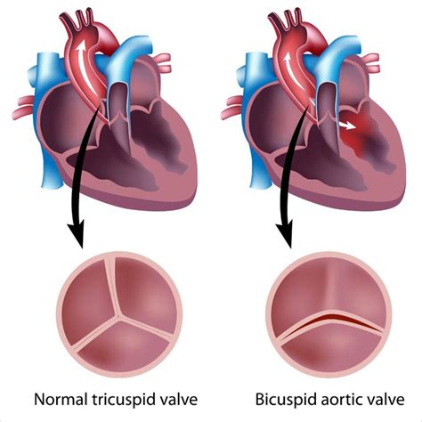 Bicuspid Aortic Valve - Cardiology - Highland Hospital - University of Rochester Medical Center