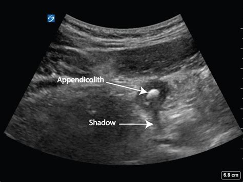 Appendicitis - Critical Care Sonography