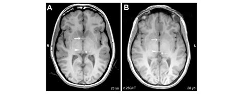 Anterior commissure, posterior commissure, and pineal gland: Axial ...