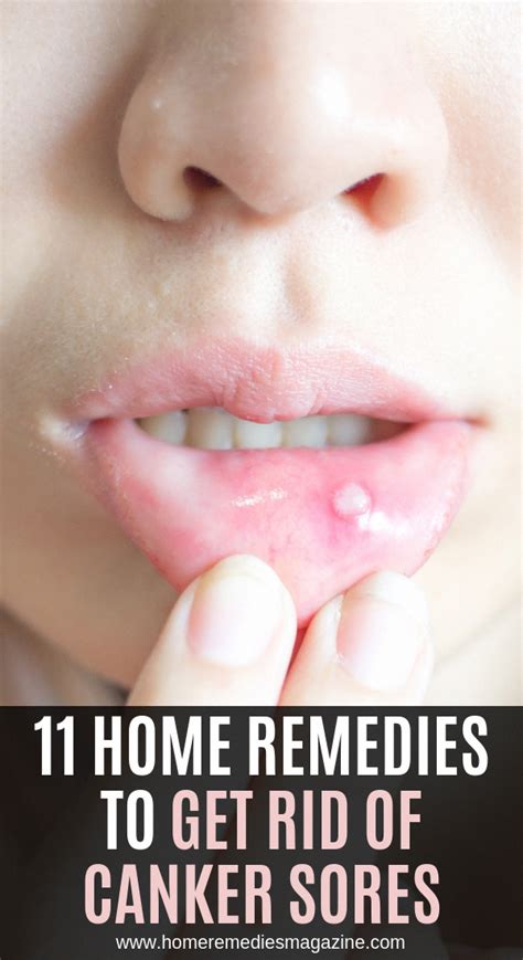 11 Home Remedies to Get Rid of Canker Sores #ImportanceOfOralHygiene #WhatAreTheOralCareTips # ...