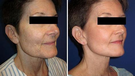 What is the Recovery Time for a Neck Lift? | Wall Township Neck Lift | Karolak Plastic Surgery ...