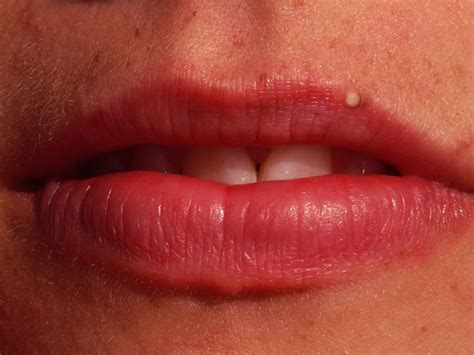 A pimple on lip : Causes and Remedies - Xaidy.com | Sjogrens syndrome, Sjogrens, Dry skin care