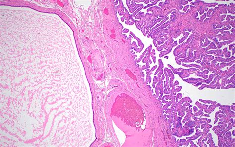 Fallopian Tube Cyst Histology