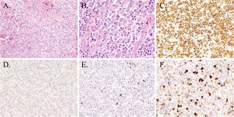 Figure3.Inguinal lymph node biopsy. Lymph node biopsy shows loss of... | Download Scientific Diagram