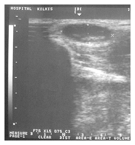 Dermoid cyst ultrasound - wikidoc