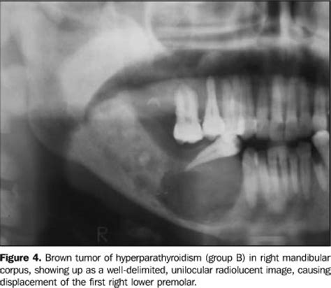 Central Giant Cell Granuloma Mandible